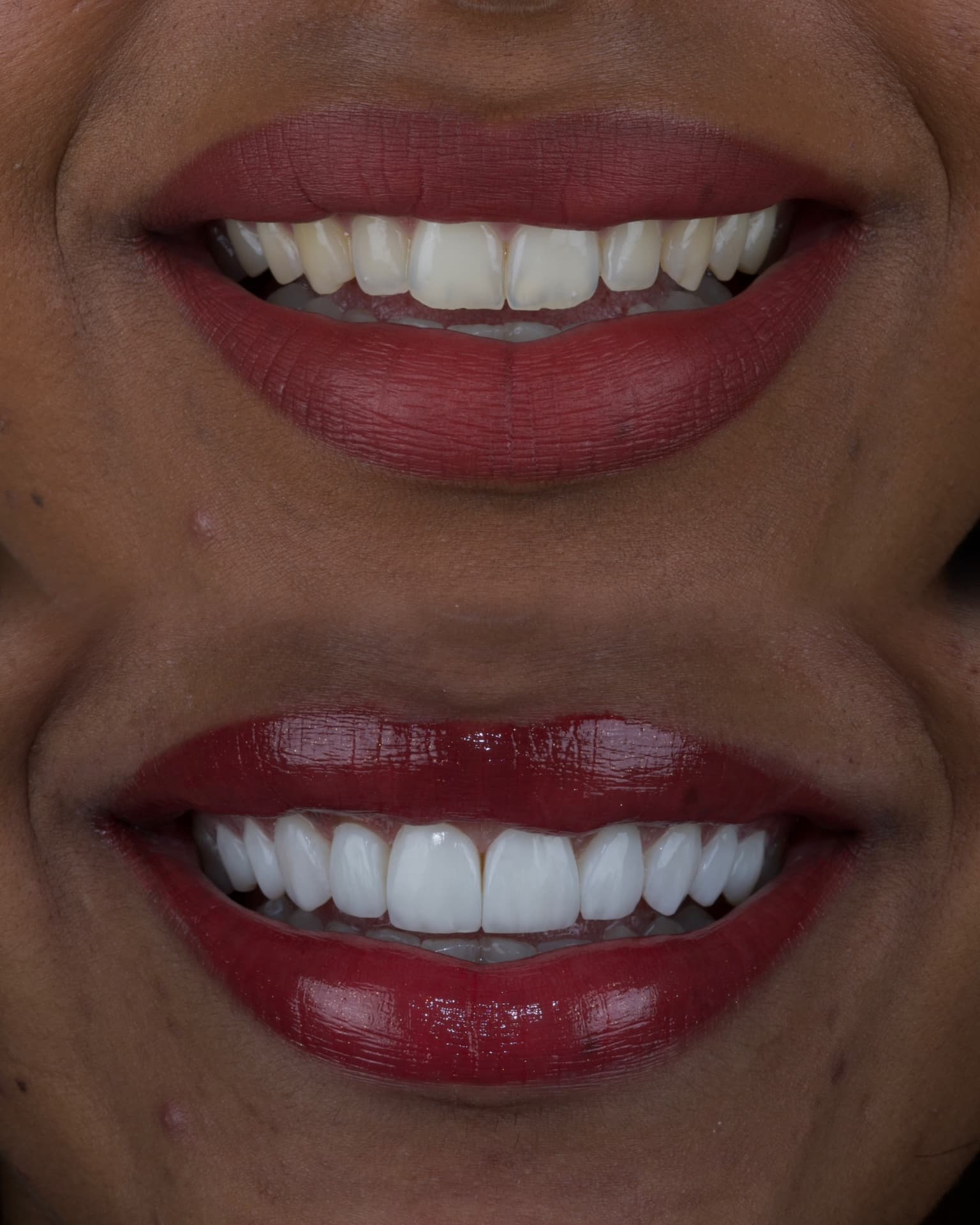 Antes e depois de um caso de facetas de resina, sorriso feminino